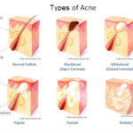 types acne